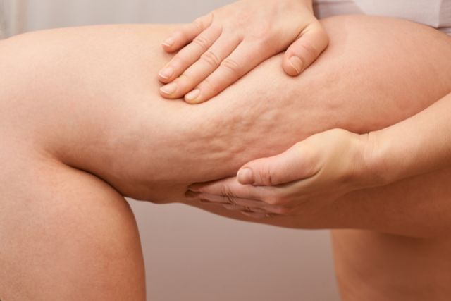 frau-cellulite-oberschenkel